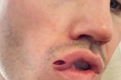 Shane McGuigan shows off gruesome split lip which requires stitches after being punched in face by..
