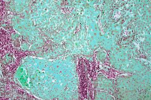 Urgent warning as cases of deadly cancer hit record highs – the 4 signs in your mouth you must not..