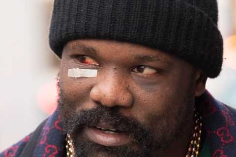 Derek Chisora shows off gruesome-looking eye injury after Tyson Fury defeat as he shops for scented ..
