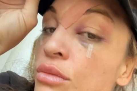 Bare-knuckle boxer Tai Emery, who famously flashed crowd, suffers gruesome facial injuries in..