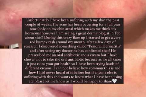 Maura Higgins forced to get medical help as she reveals painful rash on face
