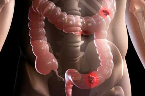 Warning as popular drinks ‘increase your risk of bowel cancer by 7%’ even if you have just one a day