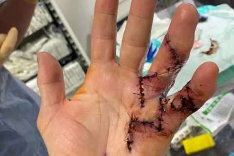 Ricky Hatton undergoes serious operation on hand after contracting rare disease that forced him to..