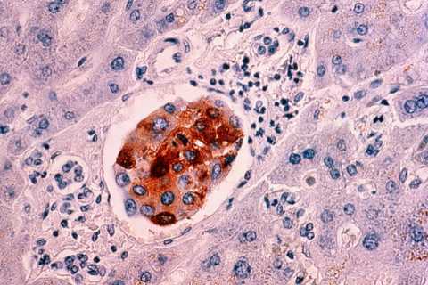 The surprising factor that raises your breast cancer risk – and 4 other risks you need to know