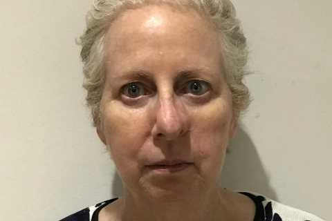 I’m sharing a photo of my reconstructed nose so that others don’t miss key cancer signs