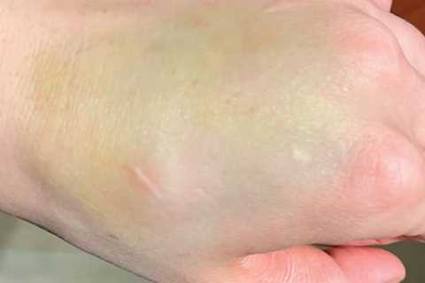 Woman shocked as ‘harmless’ bruise turns out to be surprising cancer sign