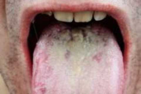The sign on your tongue that could be cancer – and 4 other symptoms to know