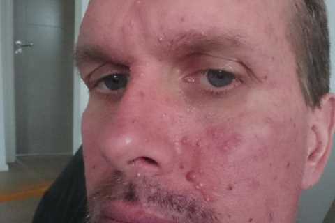 I looked like Freddy Krueger after bowel cancer spread through my body – here was the first warning ..