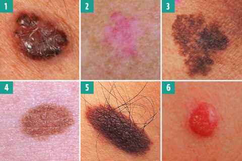 Can you spot the deadly moles from the harmless ones? The skin cancer signs you must never ignore