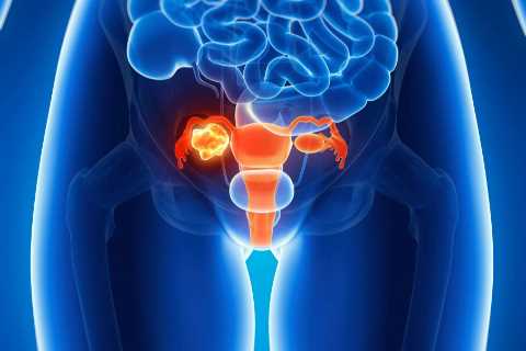 Common painkiller decreases the risk of silent killer cancer, scientists warn