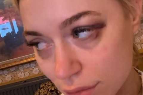 ‘War wounds’ – OnlyFans star-turned-boxer Elle Brooke shows off two black eyes after sparring with..