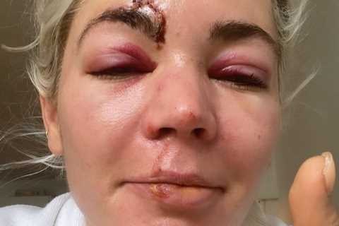 Danni Menzies reveals she’s still suffering from vertigo six months after horror moped smash