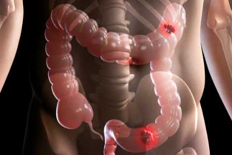 Bowel cancer symptoms: What are the first signs and when should I get a screening?