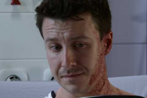 Coronation Street brings in Hollywood experts for Ryan Connor’s grisly acid attack injuries