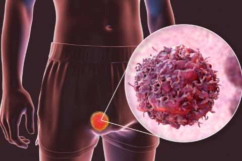 Testicular cancer more likely in millions of Brits with common conditions – are you at risk?
