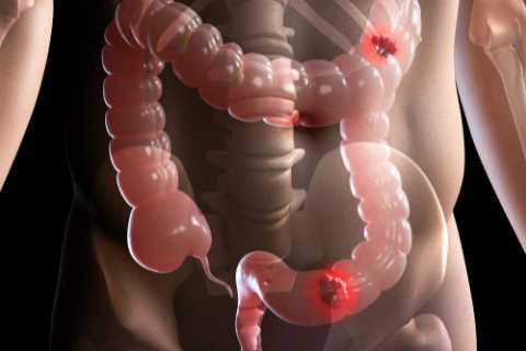 Adding ‘super veg’ to your diet can ‘slash your risk of deadly bowel cancer’