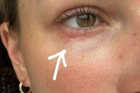 Zara McDermott struck with mystery skin condition as she begs fans for help to find cure