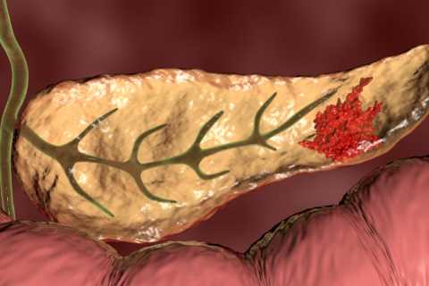 Two ‘silent’ symptoms of pancreatic cancer revealed – plus 8 other signs