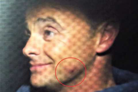 Ant McPartlin seen with a bruised and swollen face after nasty fall on Britain’s Got Talent