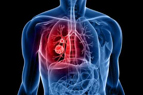 ‘Game-changing’ lung cancer drug halves the risk of death, says ‘thrilling’ study
