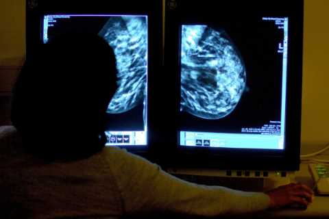 AI is ‘BETTER at spotting killer breast cancer than doctors’, scientists discover