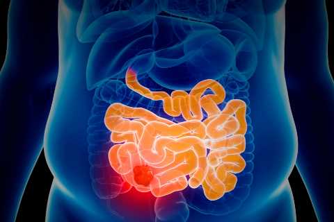 Bowel cancer treatment breakthrough as scientists solve decades-long immune system mystery