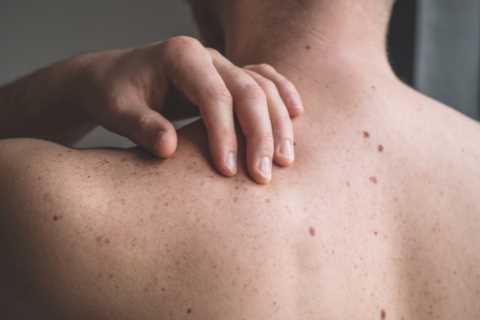 I’m a GP – the changes in your moles that could mean you’ve got skin cancer
