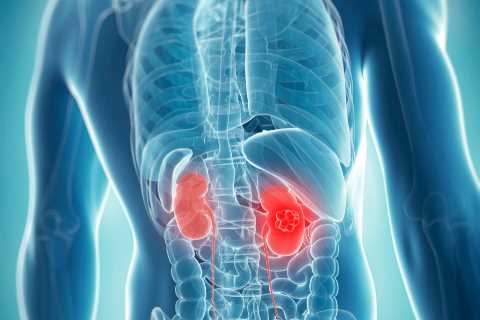 The ‘silent’ symptom of killer kidney cancer that strikes at night – and 6 other signs you must..
