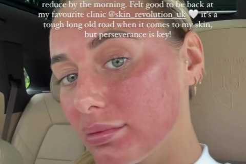 Love Island’s Millie Court reveals her ‘real’ skin after decade-long battle with acne