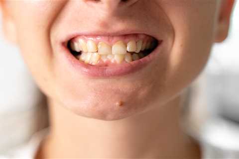I hate my teeth so I paid £637 to get veneers but I’m not happy – can you help me get my money back?