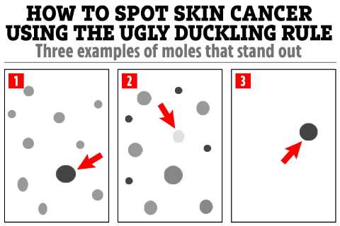How to Spot Skin Cancer Using the Ugly Duckling Rule Amid UK Heatwave