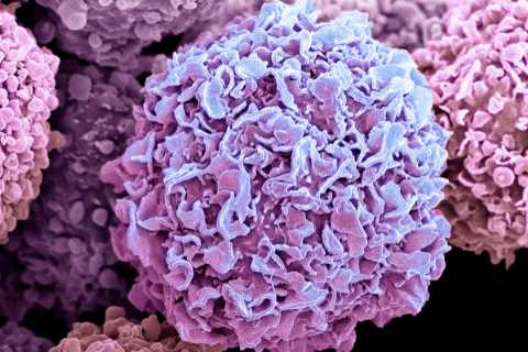 Cancer rates in under-50s have surged by 79% in 30 years, study finds