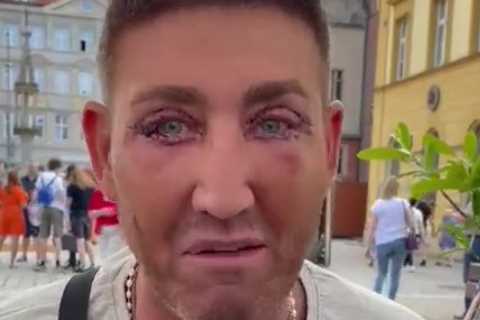 X Factor Star Christopher Maloney Reveals Bruised Eyes Following Eyelid Surgery in Poland
