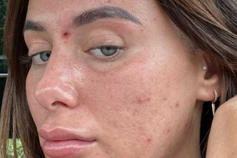 Love Island's Millie Court opens up about her acne battle and seeks new treatment