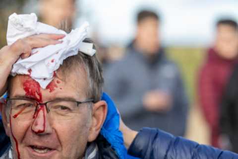 Spectator Left Bloodied After Being Hit by Golf Ball at Dunhill Championship