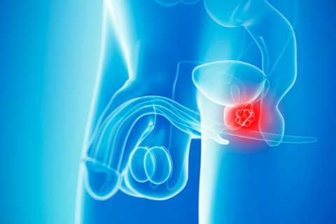 3 Questions That Can Predict Your Risk of Prostate Cancer in 30 Seconds