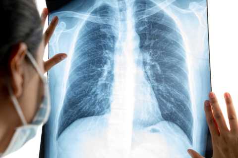 New AI tech to be rolled out at 64 NHS hospitals to help spot deadly lung cancer faster
