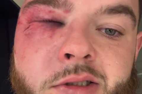 Power Slap Star Left Unrecognisable with Swollen Eye Following Brutal Defeat