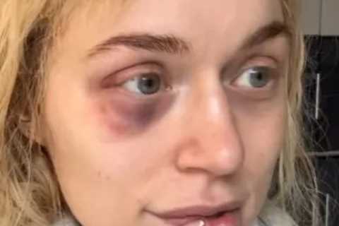 Elle Brooke Left with Horror Black Eye after Sparring Session