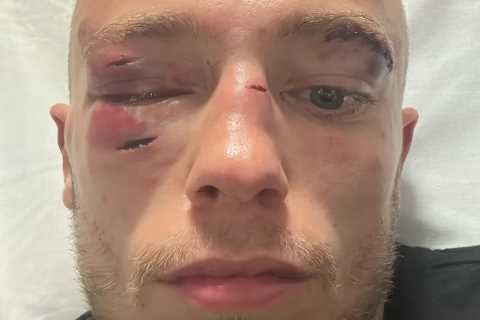 UK Boxer Sunny Edwards Reveals Horror Facial Injuries After First Professional Defeat