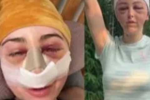 MAFS UK Star Ella Morgan Shares Throwback Snaps After Facial Surgery
