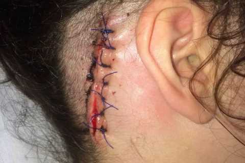 The Traitors Star Charlotte Reveals Massive Scar from Emergency Brain Surgery Ahead of Show