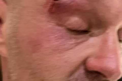 Tyson Fury Withdraws from Usyk Fight Due to Sparring Cut, Could Be Out for Months
