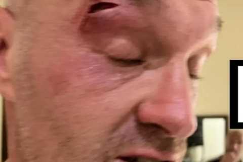 Tyson Fury Accused of Staging Elbow Injury to Avoid Oleksandr Usyk Fight