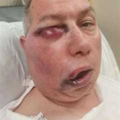 Cricket umpire left unrecognisable after horror facial injuries but says he ‘feels like he won..