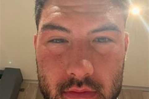 Love Island winner Liam Reardon shares shocking photo of swollen face after food poisoning nightmare