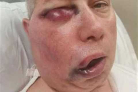 Cricket umpire left unrecognisable after horror facial injuries but says he ‘feels like he won..