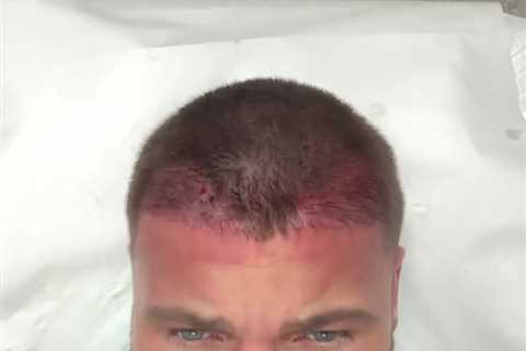 Former Love Island Star Reveals Painful Procedure to Prevent Hair Loss