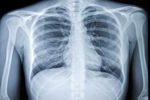 Experts call for Brits with lung cancer symptoms to be able to self-refer for tests