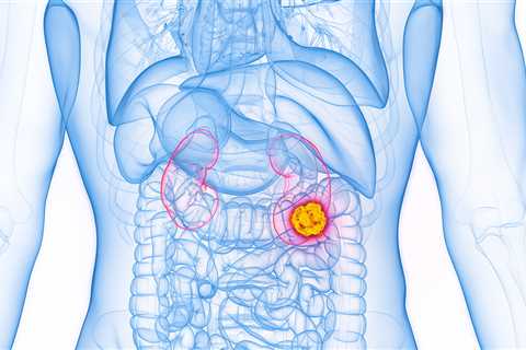 Chilling report reveals four in five kidney cancer cases spotted by accident